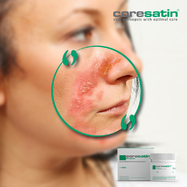 coresatin® Propolis Itch Relief - Purifying Cream, 30 g