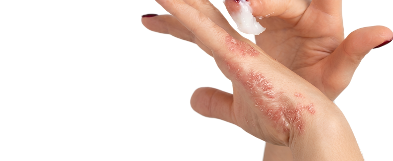 Psoriāze